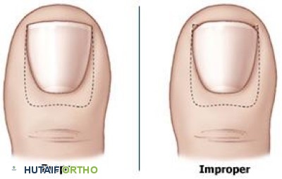 القص الصحيح وغير الصحيح لأظافر القدم